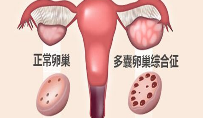 多囊性卵巢症候群
