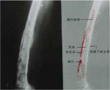 本品用于骨髓炎治疗 本品用于骨髓炎治疗