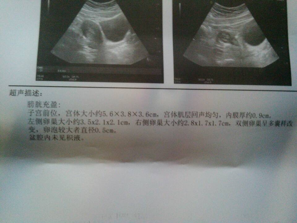 双侧多囊卵巢