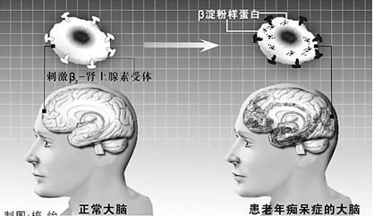 遗忘障碍人体图解 遗忘障碍人体图解