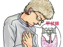 甲状腺功能亢进伴发精神障碍 甲状腺功能亢进伴发精神障碍