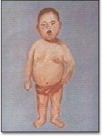 先天性甲状腺功能减低症患儿 先天性甲状腺功能减低症患儿