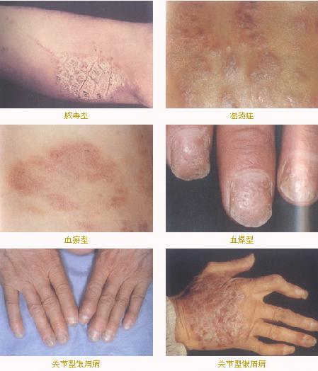 肺类风湿性病