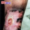 继发性Raynaud综合徵