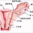 输卵管粘连