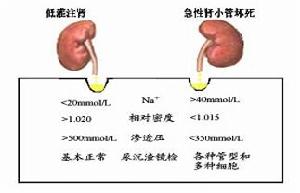 肾前性 肾前性