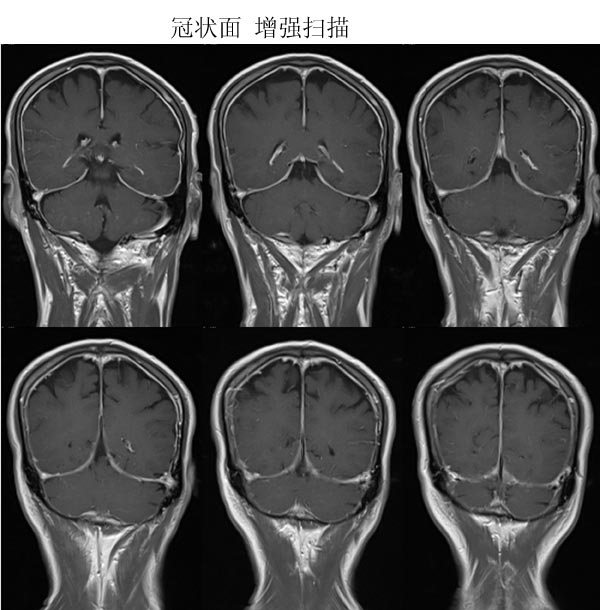 低颅压综合症