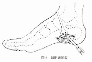 脊髓前角灰质炎 脊髓前角灰质炎