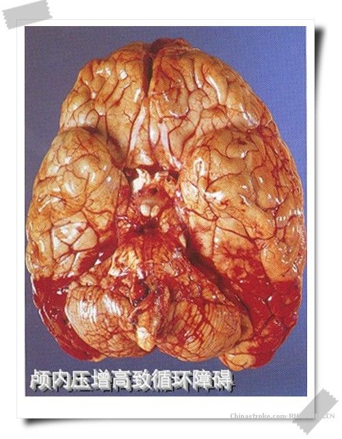 颅内压增高综合症 颅内压增高综合症