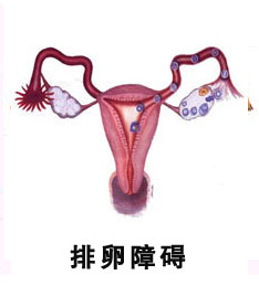 排卵障碍 排卵障碍