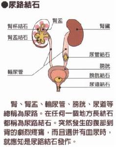 尿路结石 尿路结石