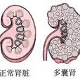 肾前性肾功能衰竭
