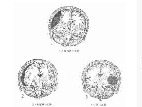 颅脑损伤后头痛 颅脑损伤后头痛
