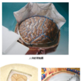 人工硬脑膜