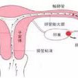 输卵管性不孕症