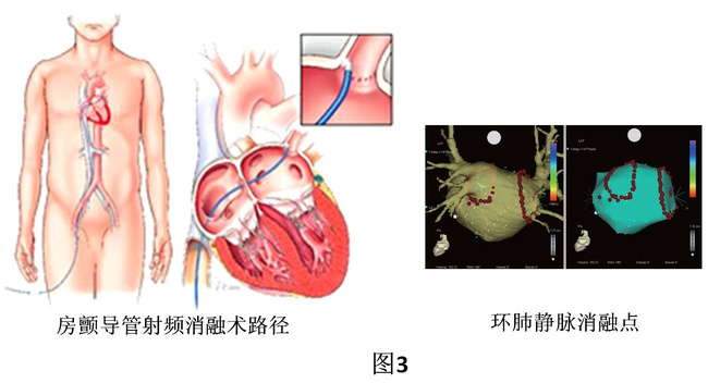 心脏射频消融术