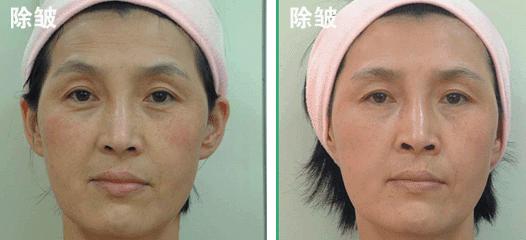 玻尿酸除皱前后效果图 玻尿酸除皱前后效果图