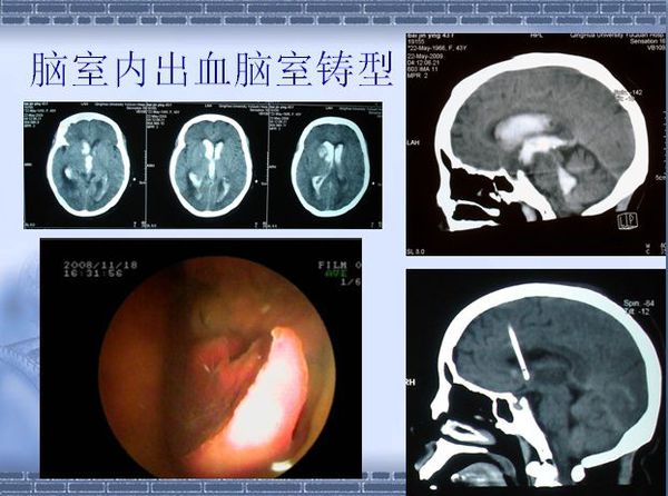 丘脑血肿清除术