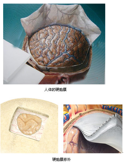 人工硬脑膜 人工硬脑膜