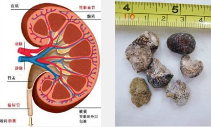 尿路结石 尿路结石