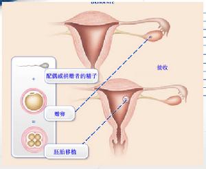 IVF-ET IVF-ET