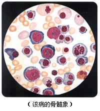 原发性血小板减少性紫瘢 原发性血小板减少性紫瘢
