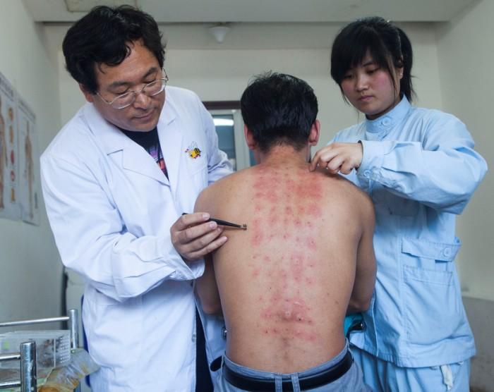 蜜蜂疗法