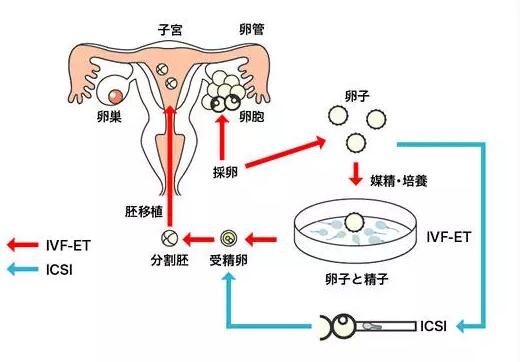 IVF-ET