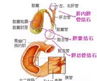 胆结石分类 胆结石分类