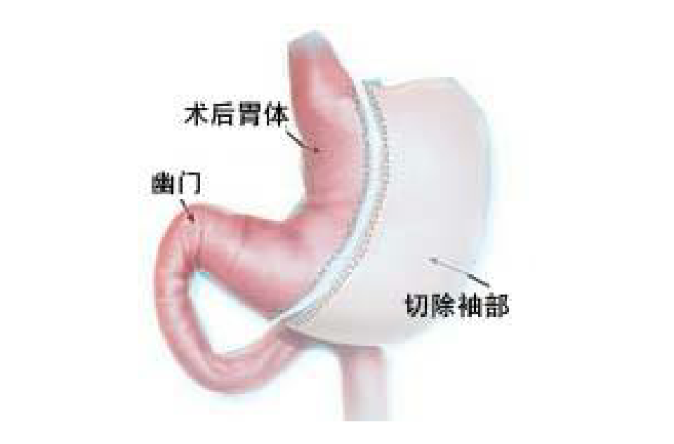 缩胃手术